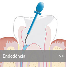 TRACTAMENTS-endodoncia