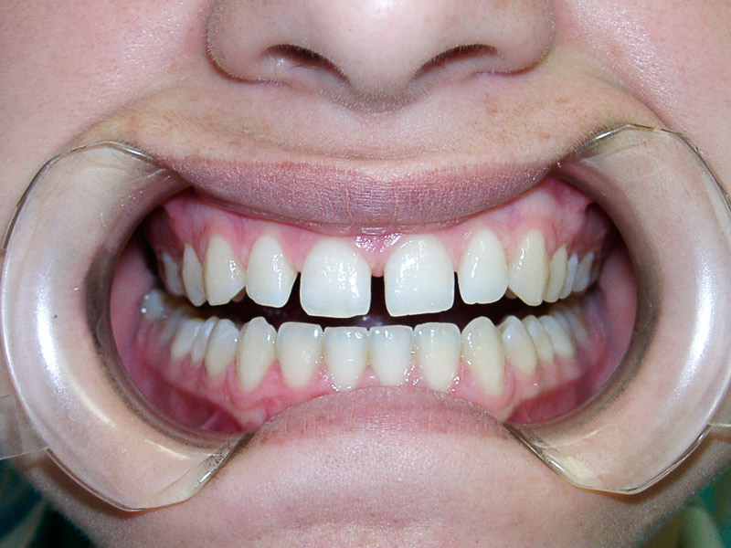 Abans i després de reconstrucció dental estètica